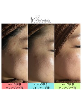 リノレリチア 心斎橋 新町店/KMPハーブピーリング