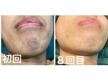 バズ 学園店(BUZZ)の雰囲気（【見た目が変わる！？お顔脱毛！】お顔全部丸ごと脱毛できます♪）