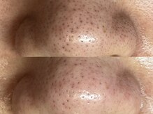 フレーズ(fraise)/毛穴エクストラクション