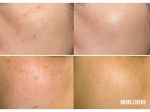 ナチュレアンドメディカ(Nature&Medica)/顔脱毛＋シミケアフェイシャル