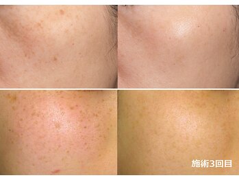 ナチュレアンドメディカ(Nature&Medica)/顔脱毛+シミケアフェイシャル
