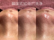 ビヨンド リンク(BEYOND L'INK)/韓国式3D毛穴洗浄