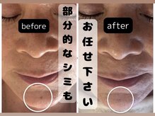 サロン ドロップ 上小田井(Salon drop)/「シミ改善」