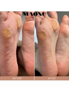 マオヌー(MAONU)/韓国式足裏角質ケア　症例写真