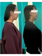 西宮ヤノ整骨院/首と肩凝りで、お悩み40代女性