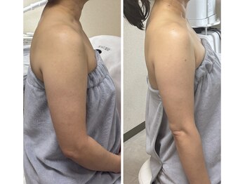ルマエクレ(rmaecla)の写真/横から5kg痩せ見え。二の腕は"肩から"細くする。