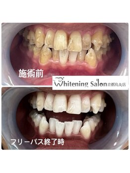 ホワイトニングサロン 京都烏丸店/ホワイトニングニング施術例