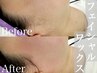 【毛穴&角質ケア】マツヤニ不使用◆フェイシャルワックス脱毛￥8,480→¥7,980