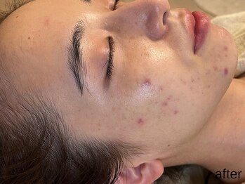 サロン ド エメ(salon de aimer)/【After】一気に赤みが鎮静♪