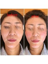 美藤鍼灸院/美容鍼のBefore After