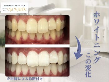 シアホワイト(CIA WHITE)/劇的ビフォーアフター