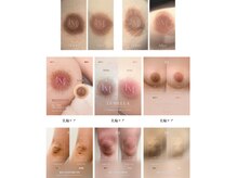 フリュール(FLEUR)の雰囲気（大注目のルメラのメラニンケア☆一度でこの変化♪）