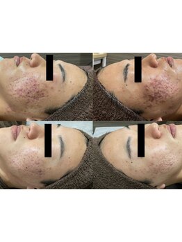 メンズフェイシャル