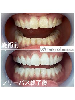 ホワイトニングサロン 京都烏丸店/ホワイトニング施術例