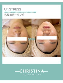 ルミア(Rumia)の写真/乳酸菌ピーリングで美肌を目指し、繰り返す肌トラブル改善をサポートします◎