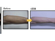 ヴィオール 名古屋栄店(VIOR)/【メンズ脱毛】　腕