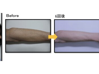 ヴィオール 名古屋栄店(VIOR)/【メンズ脱毛】　腕