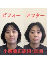 オズ六本木/六本木小顔矯正(造顔)施術1回