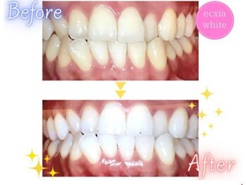 エクシアホワイトニング 旭橋店