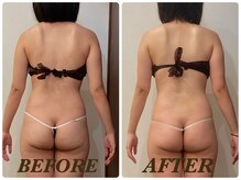 プリマ(Prima)/【2回施術】　BEFORE&AFTER