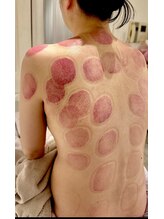 ビレイ(Birei)/カッピング