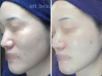 アート ビューティールーム(art beauty room)/☆XE'LHA PEEL & ポレーション