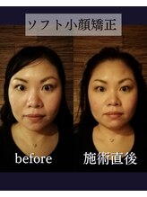 ヘッドラボ(Headlabo★3103)/ソフト小顔矯正