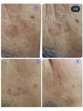 シェアキ(Chez Aki)/シミケアBefore/After