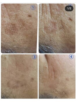 シェアキ(Chez Aki)/シミケアBefore/After