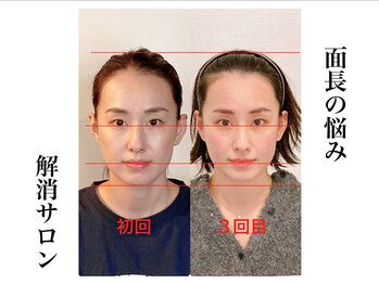 小顔22 ボルティ 赤坂支店(Bolty)/【面長＝中顔面】が別人級に変化