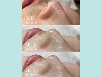 ティーツリー 名古屋 桜山(Tea Tree)/【毛穴ケア・毛穴洗浄】