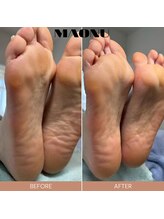 マオヌー(MAONU)/韓国式足裏角質ケア　症例写真