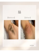 ルウム 金山店(lum)/脱毛lum/脇　Before/After