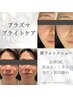 【掲載記念】札幌希少のプラズマ顔脱毛