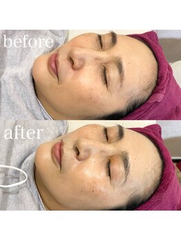 プラスキュア 用賀店(+CURE)/【フェイシャル】美肌パック