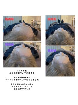 ミコット/筋膜アプローチの変化