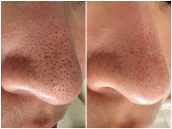 マヴィ くずは店(MavY.)/しつこい、いちご鼻解消へ