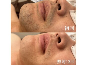 ダリオムズ 西宮北口(DAHLI HOMMES)/☆メンズヒゲ脱毛☆照射12回目