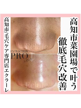 エクラーレ(Eclale)/【毛穴ケア】症例
