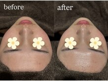 ビビ(Vivi)/¥赤ら顔・赤み改善/