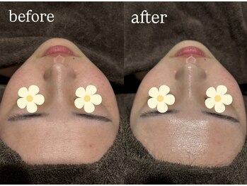 ビビ(Vivi)/¥赤ら顔・赤み改善/