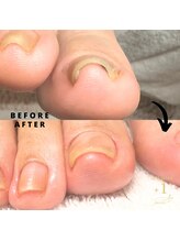 プラスワン(+1)/フット巻き爪矯正