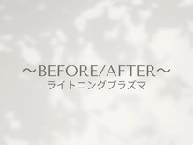 ビー(Be.)/プラズマbefore/after