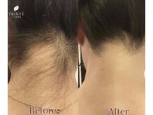 トリンテ バイ フェース(TRINTE by FAITH)/【うなじ脱毛】6回（4週間隔）