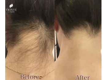 トリンテ バイ フェース(TRINTE by FAITH)/【うなじ脱毛】6回（4週間隔）