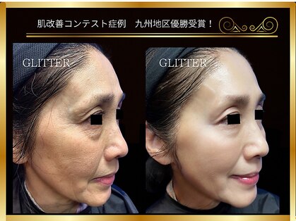 グリッター(GLITTER)の写真