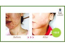 カンコルギセラピー 広島幟町店(KAN)/ハーブピーリング