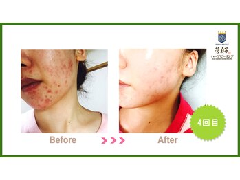 カンコルギセラピー 広島幟町店(KAN)/ハーブピーリング