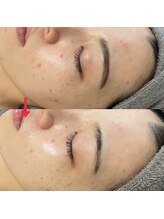 ダリア(Dahlia)/ハーブピーリング