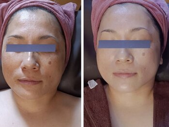 シャルマン(charmant)/エクソソーム導入　1回